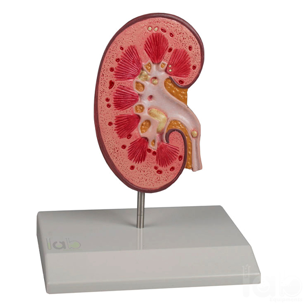 Kidney Stone Model